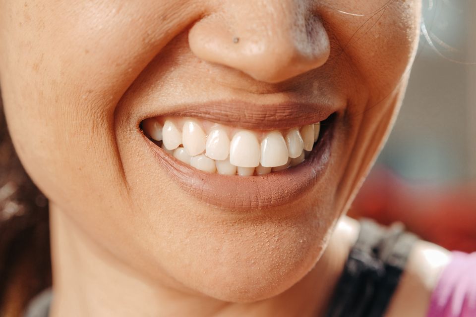 Healthy bright smile after root canal and crown
